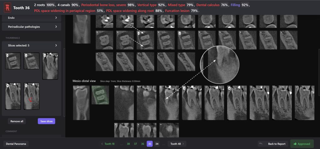Treatment of severe periodontal disease 10 Treatment of severe periodontal disease 9