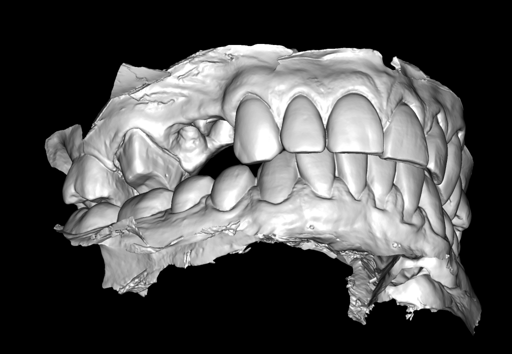Planning implantation using Diagnocat AI 8 Planning implantation using Diagnocat AI 7