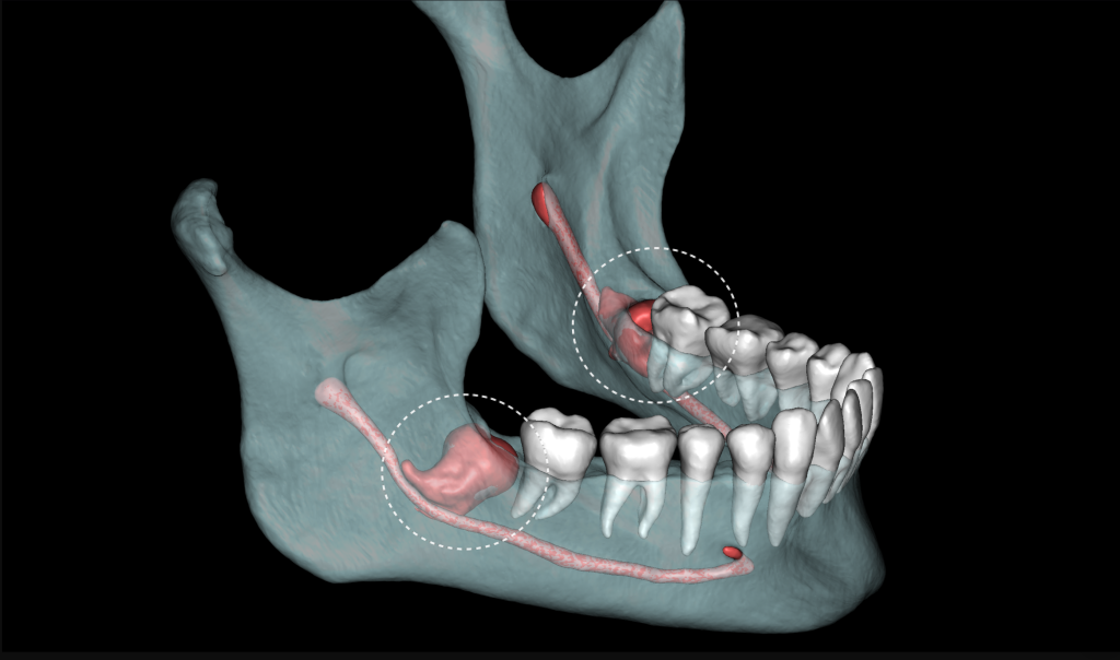 Third molar impaction - additional methods of analysis and extraction planning 2 Third molar impaction - additional methods of analysis and extraction planning 1