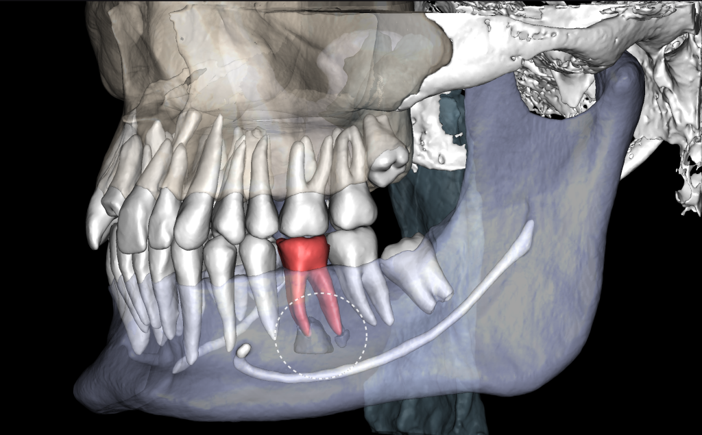 Diagnosis of frequent endodontic complications with Diagnocat 2 Diagnosis of frequent endodontic complications with Diagnocat 1