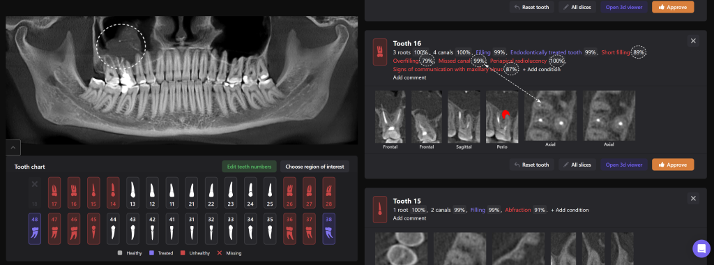 Odontogenic sinusitis associated with periapical lesion 4 Odontogenic sinusitis associated with periapical lesion 3