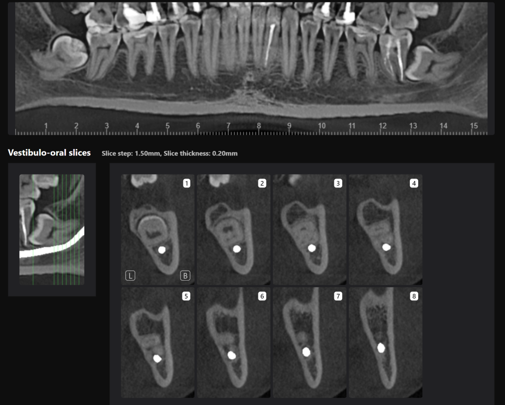 Third molar impaction - additional methods of analysis and extraction planning 6 Third molar impaction - additional methods of analysis and extraction planning 5