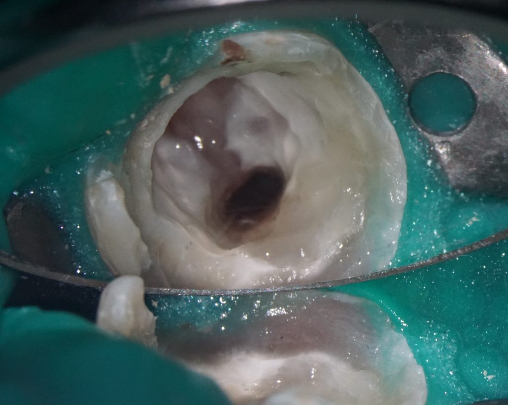 Diagnosis of frequent endodontic complications with Diagnocat 6 Diagnosis of frequent endodontic complications with Diagnocat 5