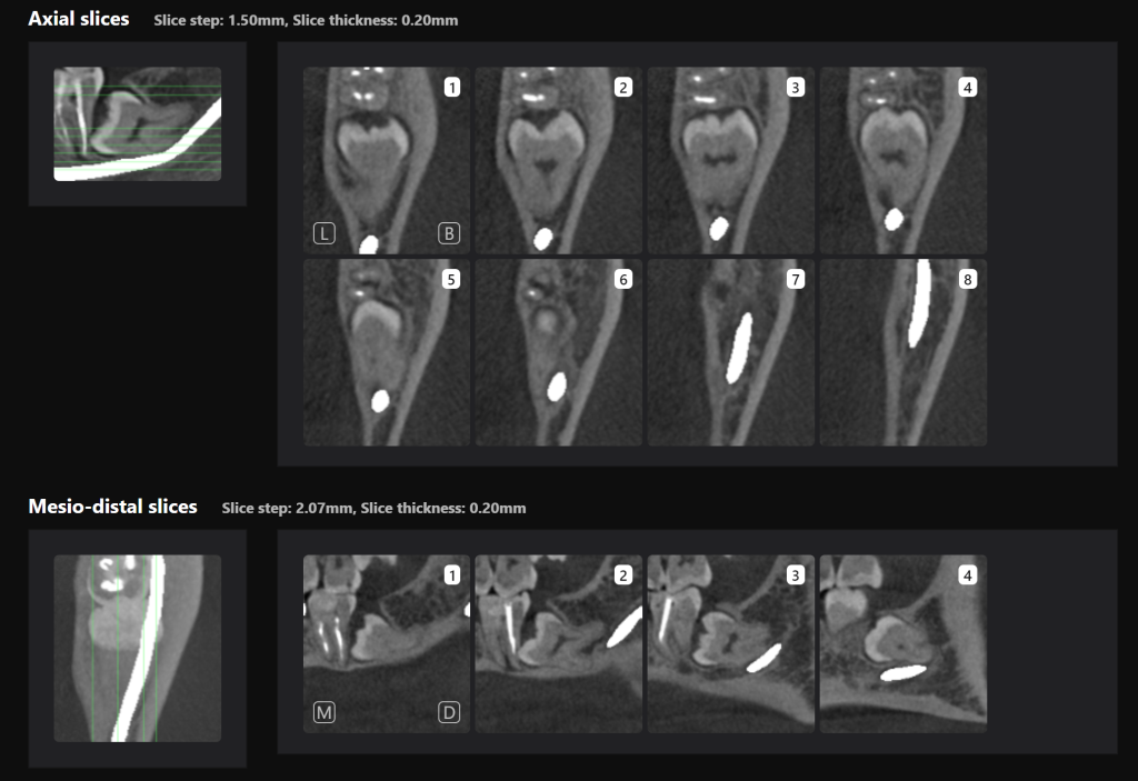 Third molar impaction - additional methods of analysis and extraction planning 8 Third molar impaction - additional methods of analysis and extraction planning 7
