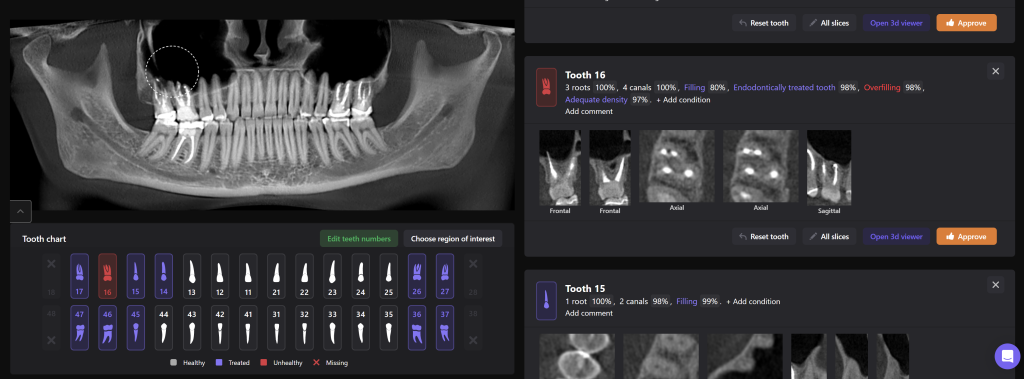Odontogenic sinusitis associated with periapical lesion 8 Odontogenic sinusitis associated with periapical lesion 7