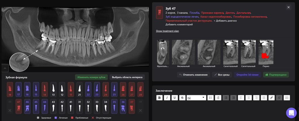 Оценка качества эндодонтического лечения с помощью Diagnocat 2 Оценка качества эндодонтического лечения с помощью Diagnocat 1