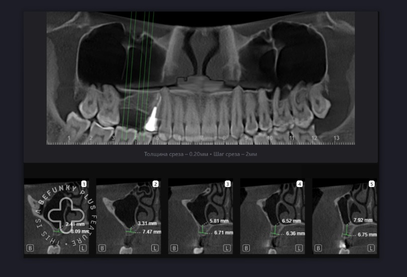 Планирование имплантации с помощью Diagnocat 8 Планирование имплантации с помощью Diagnocat 7