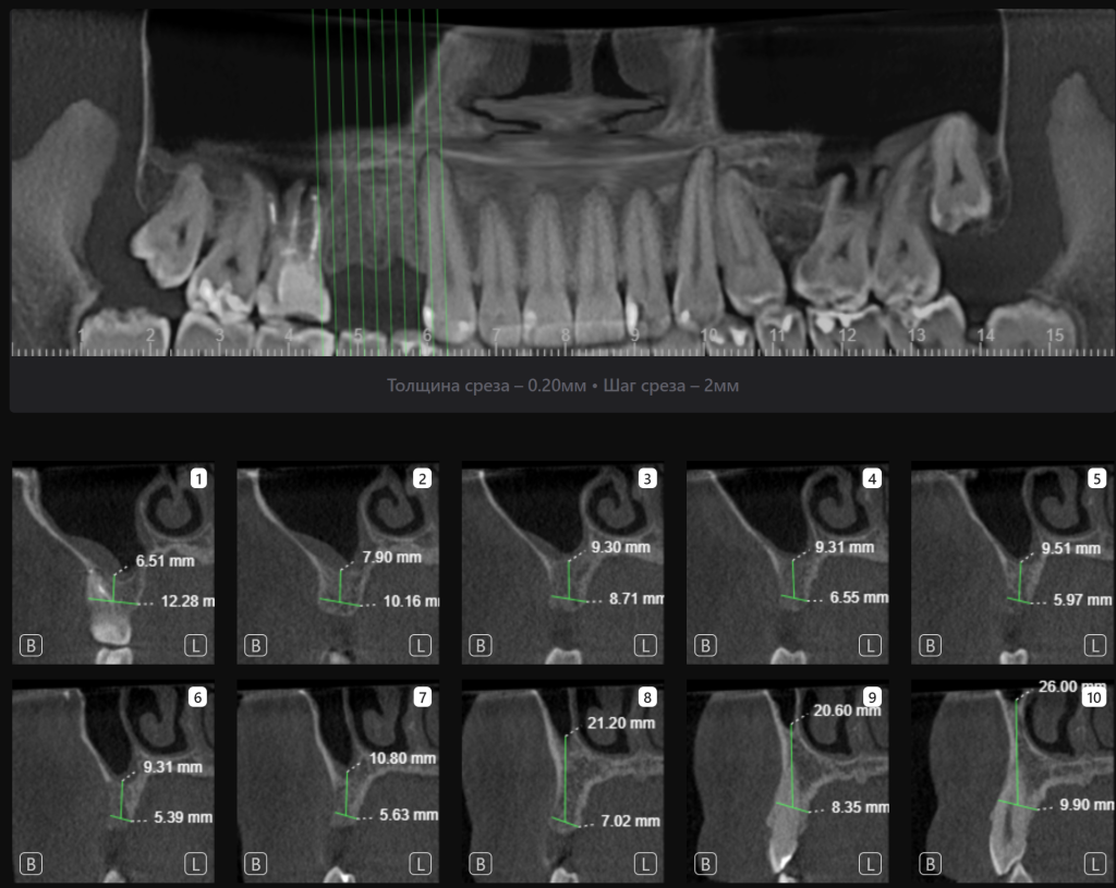 Планирование имплантации в области премоляров с использованием Diagnocat 4 Планирование имплантации в области премоляров с использованием Diagnocat 3