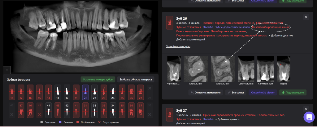 Изучите морфологию и анатомию корневых каналов с помощью Diagnocat 4 Изучите морфологию и анатомию корневых каналов с помощью Diagnocat 3