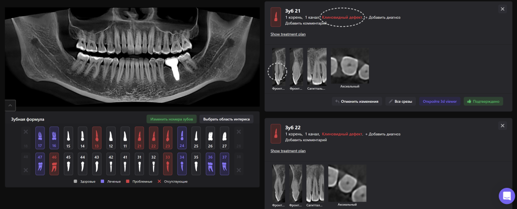 Автоматическое обнаружение некариозных поражений 4 Автоматическое обнаружение некариозных поражений 3