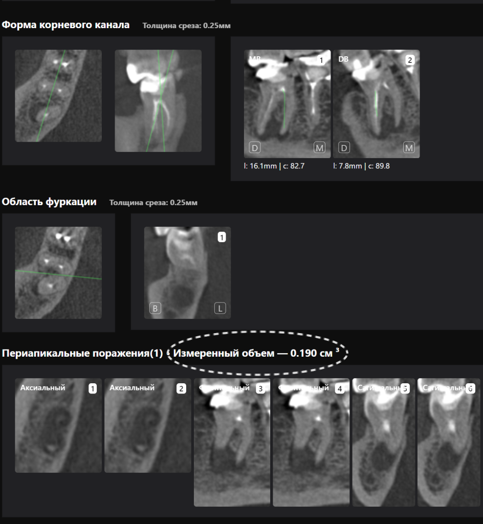 Оценка качества эндодонтического лечения с помощью Diagnocat 6 Оценка качества эндодонтического лечения с помощью Diagnocat 5