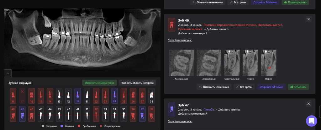 Лечение тяжелых форм заболеваний пародонта 6 Лечение тяжелых форм заболеваний пародонта 5