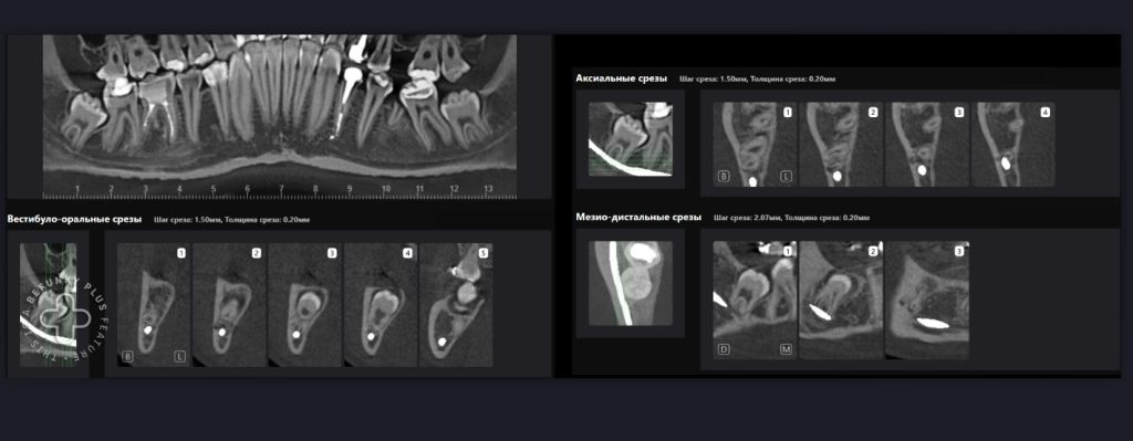 Планирование удаления третьего моляра с помощью Diagnocat 6 Планирование удаления третьего моляра с помощью Diagnocat 5