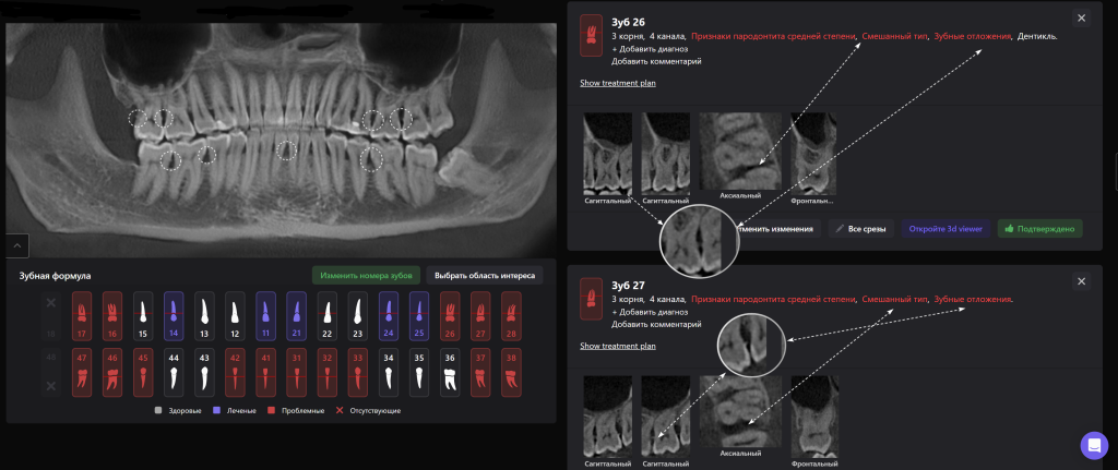 Своевременный пародонтологический скриннинг с помощью Diagnocat - залог успешного результата лечения 6 Своевременный пародонтологический скриннинг с помощью Diagnocat - залог успешного результата лечения 5