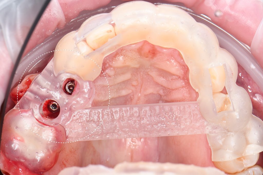 Планирование имплантации в области премоляров с использованием Diagnocat 8 Планирование имплантации в области премоляров с использованием Diagnocat 7