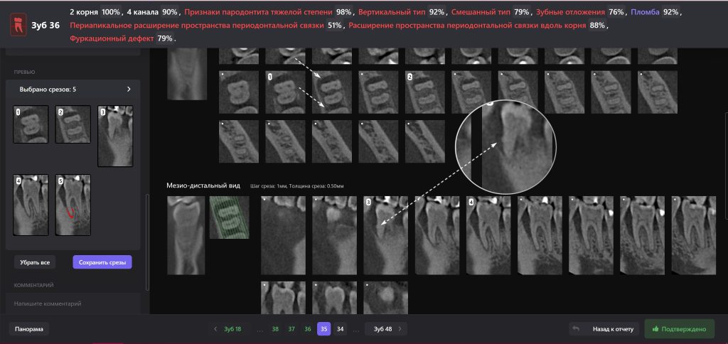 Лечение тяжелых форм заболеваний пародонта 10 Лечение тяжелых форм заболеваний пародонта 9