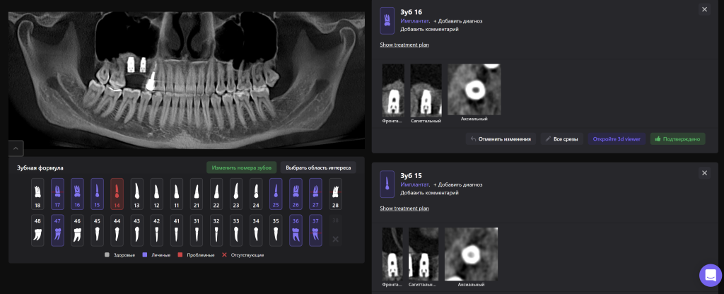 Планирование имплантации с помощью Diagnocat 10 Планирование имплантации с помощью Diagnocat 9