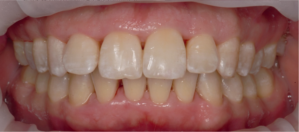 Лечение тяжелых форм заболеваний пародонта 12 Лечение тяжелых форм заболеваний пародонта 11