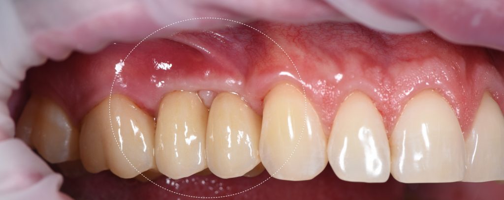 Планирование имплантации в области премоляров с использованием Diagnocat 14 Планирование имплантации в области премоляров с использованием Diagnocat 13