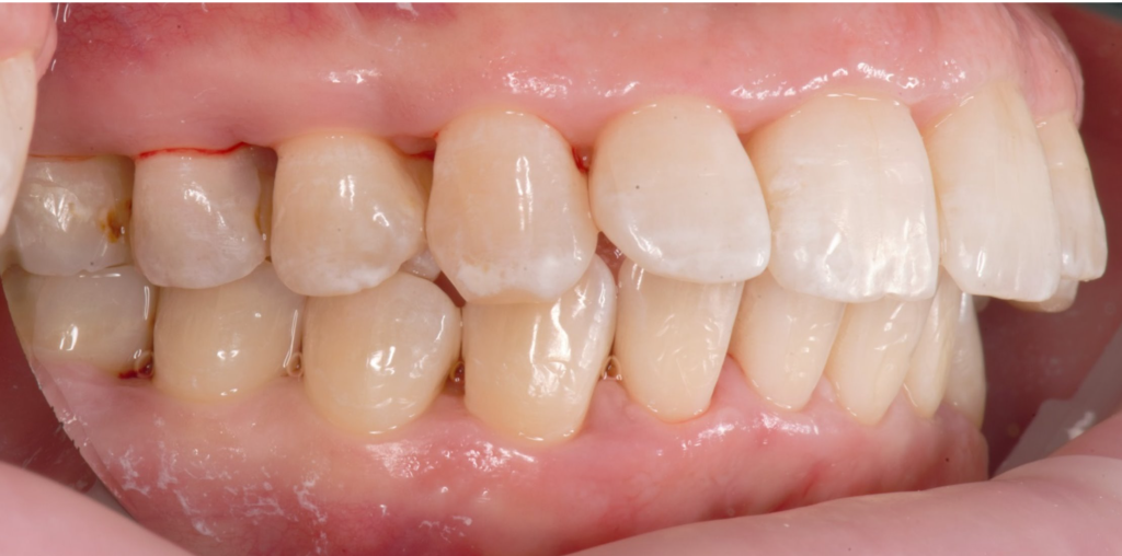 Лечение тяжелых форм заболеваний пародонта 14 Лечение тяжелых форм заболеваний пародонта 13