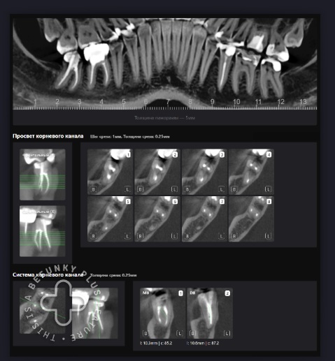 Оценка качества эндодонтического лечения с помощью Diagnocat 10 Оценка качества эндодонтического лечения с помощью Diagnocat 9