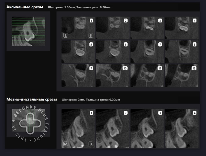 Как спланировать удаление 3 моляров с прогнозируемым результатом? 6 Как спланировать удаление 3 моляров с прогнозируемым результатом? 5