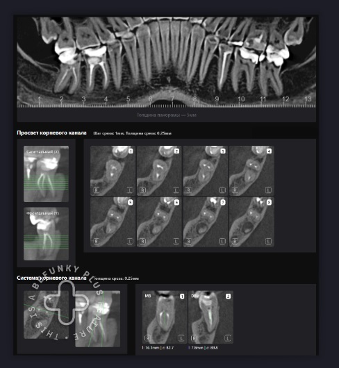 Оценка качества эндодонтического лечения с помощью Diagnocat 4 Оценка качества эндодонтического лечения с помощью Diagnocat 3