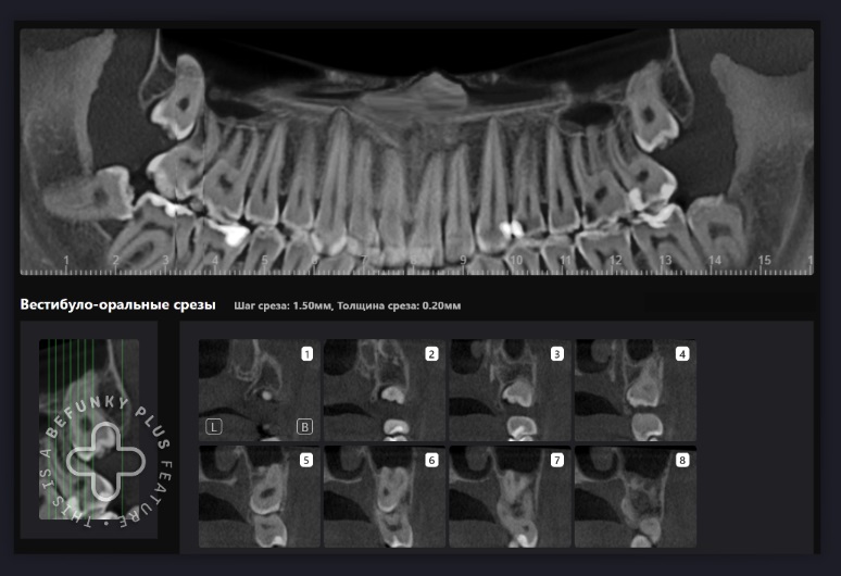 Как спланировать удаление 3 моляров с прогнозируемым результатом? 4 Как спланировать удаление 3 моляров с прогнозируемым результатом? 3